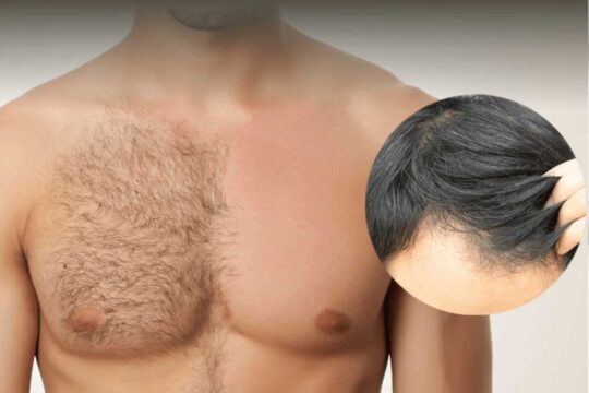 DHI Hair Transplant Prices in Turkey » TecniFUE Best Hair Transplant