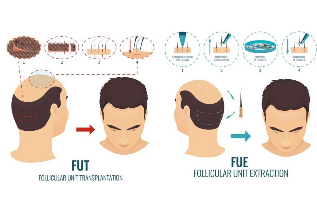 FUT + FUE Combined Hair Transplant In Turkey