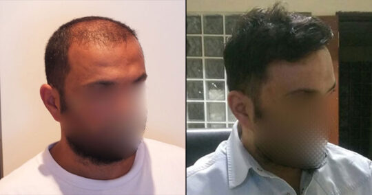 Hair Transplant Before and After 2200 Graft 5000 Hair