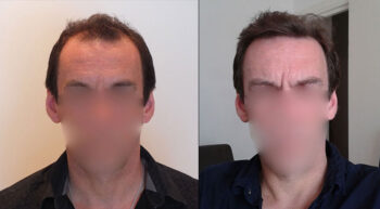 Hair Transplant Before and After 2500 Graft 6000 Hair