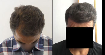 Hair Transplant Before and After 2600 Graft 6000 Hair