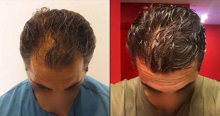 Hair Transplant Before and After 2023 | AEK Hair Clinic