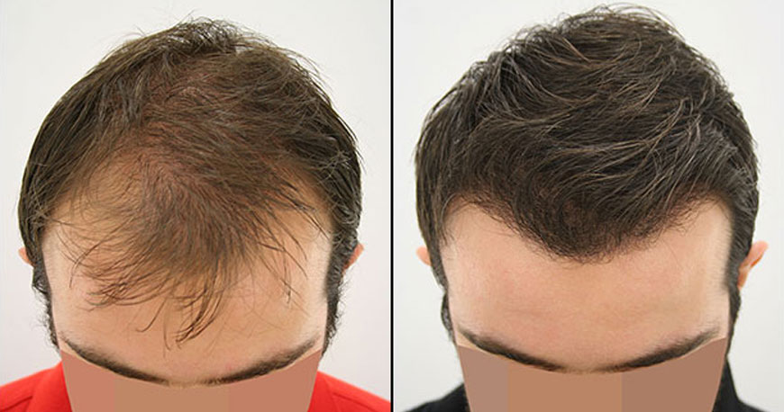 Hair Transplant Before and After 2023 | AEK Hair Clinic