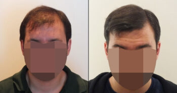 Hair Transplant Before and After 3100 Graft 7000 Hair