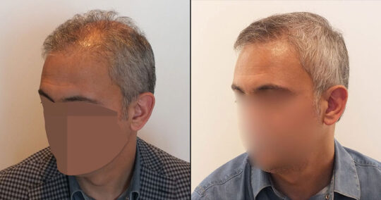 Hair Transplant Before and After 4600 Graft 10000 Hair