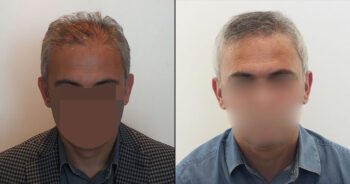 Hair Transplant Before and After 4600 Graft 10000 Hair