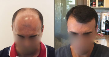 Hair Transplant Before and After 5000 Graft 10000 Hair