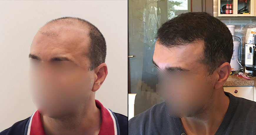 ForHair Hair Transplant Clinic ForhairClinic  Twitter