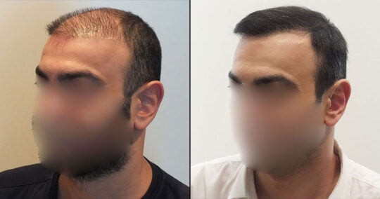 Hair Transplant Before and After 5700 Graft 12000 Hair