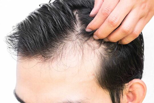 Hair Transplant Repair In Turkey