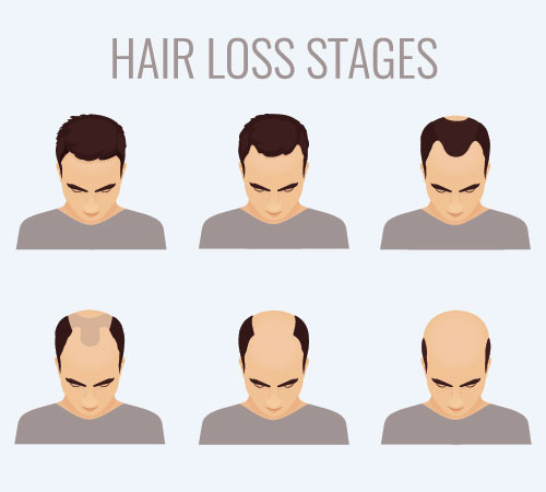 Hair Loss Stages