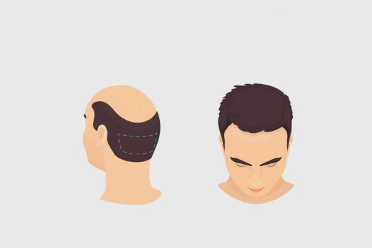 FUT + FUE Hybrid Method - Advanced Hair Transplant Option